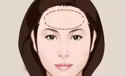 喬雅登雅致適合做哪些部位？皺紋拜拜|玻尿酸去抬頭紋案例附上